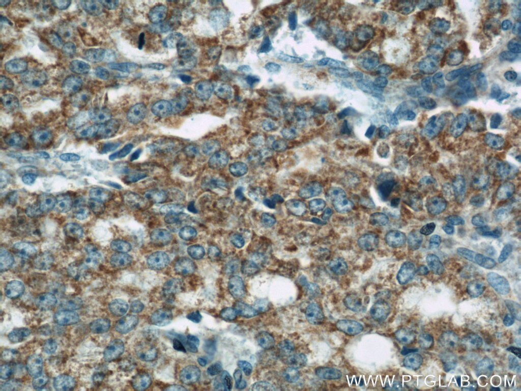 Immunohistochemistry (IHC) staining of human prostate cancer tissue using COXIV Monoclonal antibody (60251-1-Ig)