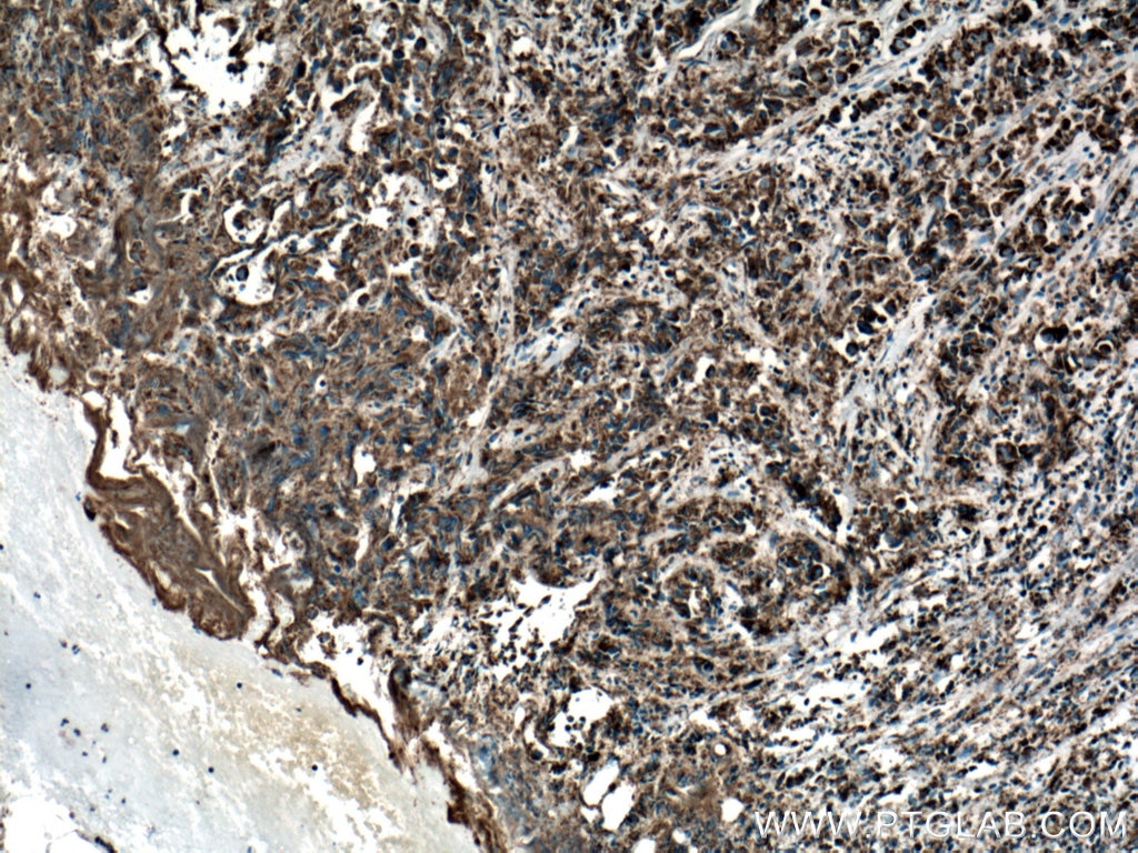 Immunohistochemistry (IHC) staining of human prostate cancer tissue using COXIV Monoclonal antibody (66110-1-Ig)