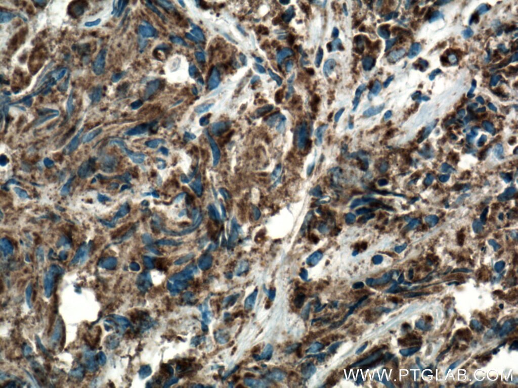 Immunohistochemistry (IHC) staining of human prostate cancer tissue using COXIV Monoclonal antibody (66110-1-Ig)