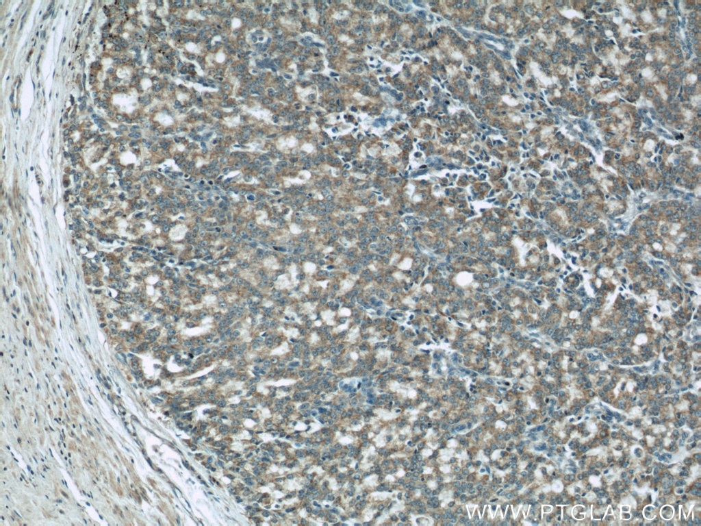 Immunohistochemistry (IHC) staining of human prostate cancer tissue using COXIV Monoclonal antibody (66110-1-Ig)
