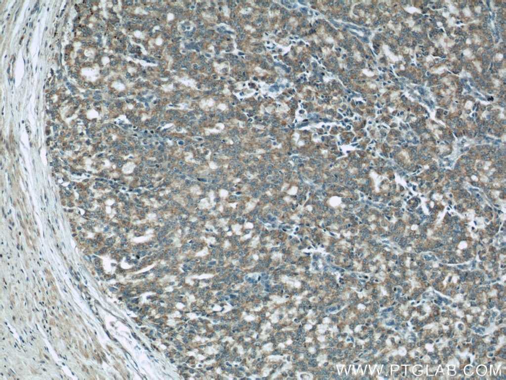 IHC staining of human prostate cancer using 66110-1-Ig