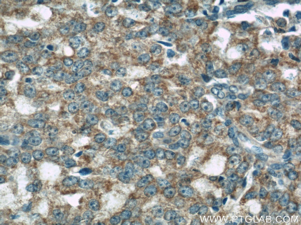 Immunohistochemistry (IHC) staining of human prostate cancer tissue using COXIV Monoclonal antibody (66110-1-Ig)