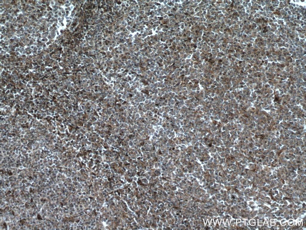 Immunohistochemistry (IHC) staining of human tonsillitis tissue using Ceruloplasmin Polyclonal antibody (21131-1-AP)