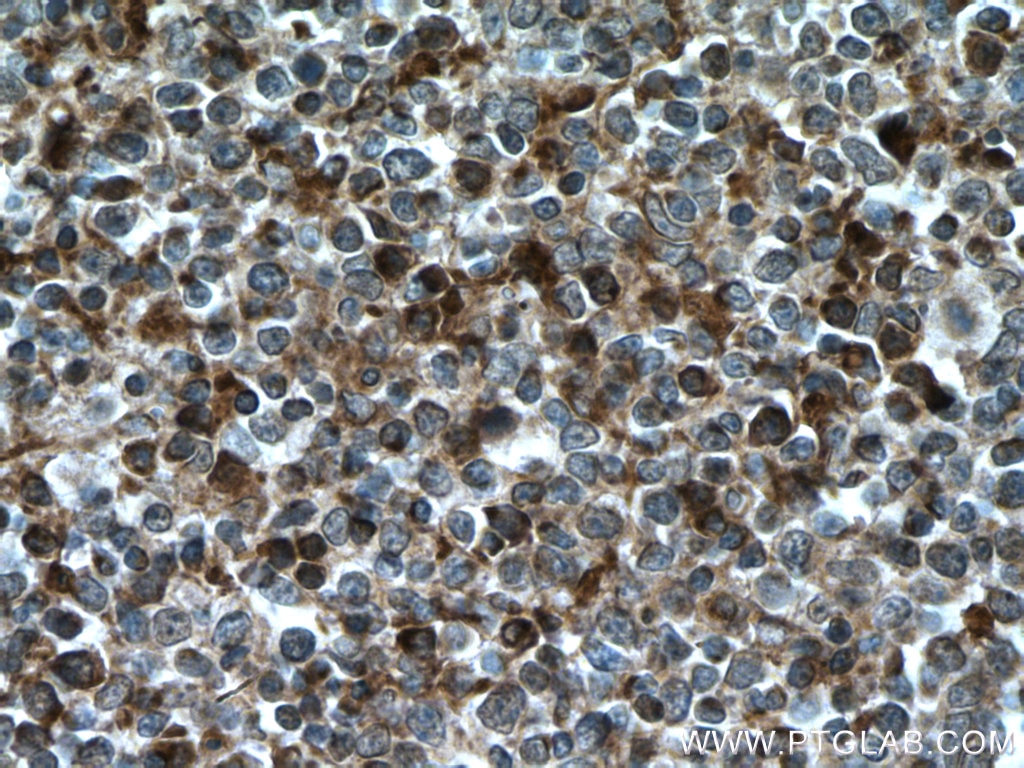 Immunohistochemistry (IHC) staining of human tonsillitis tissue using Ceruloplasmin Polyclonal antibody (21131-1-AP)