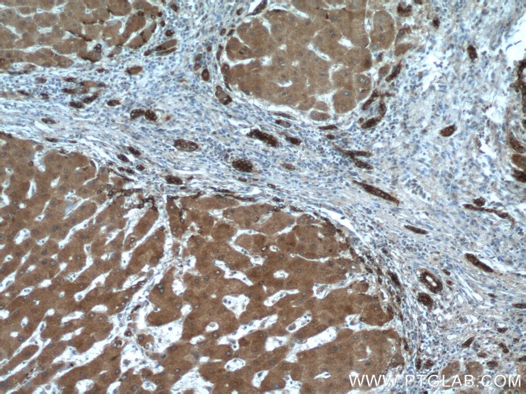 Immunohistochemistry (IHC) staining of human hepatocirrhosis tissue using Ceruloplasmin Polyclonal antibody (21131-1-AP)