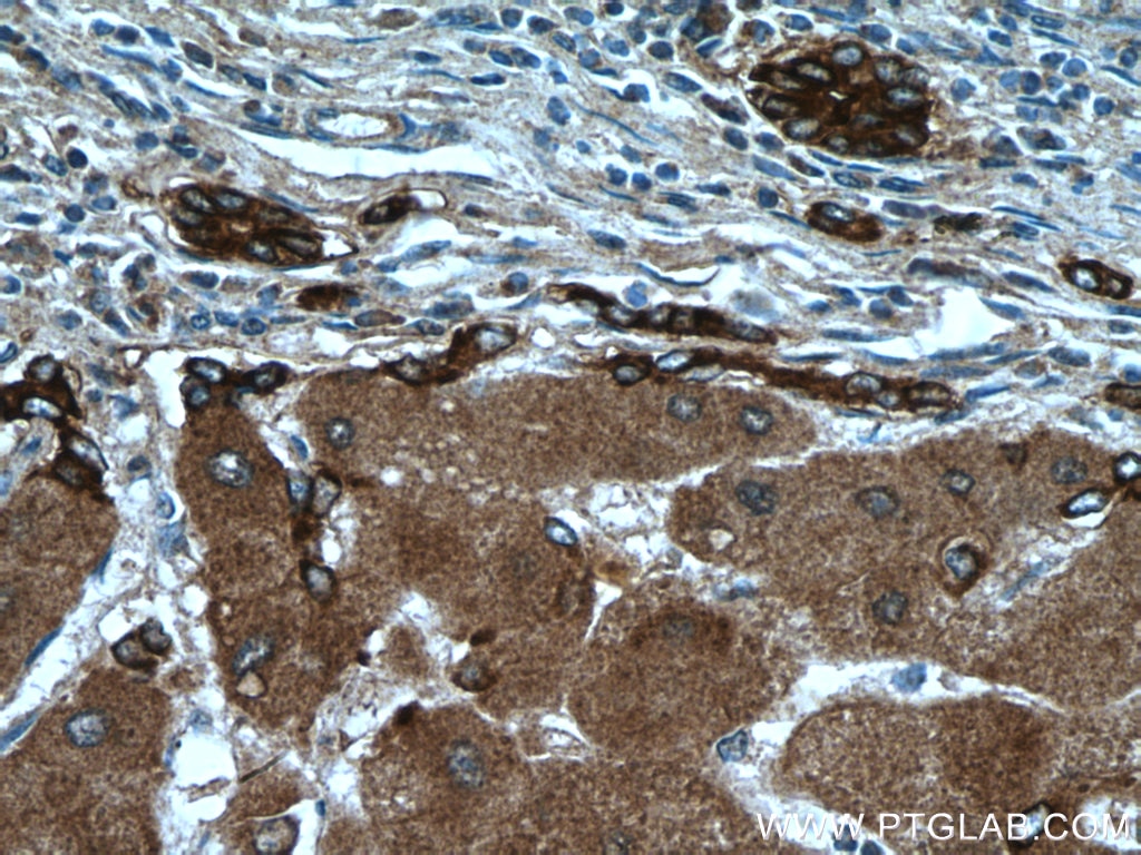 Immunohistochemistry (IHC) staining of human hepatocirrhosis tissue using Ceruloplasmin Polyclonal antibody (21131-1-AP)