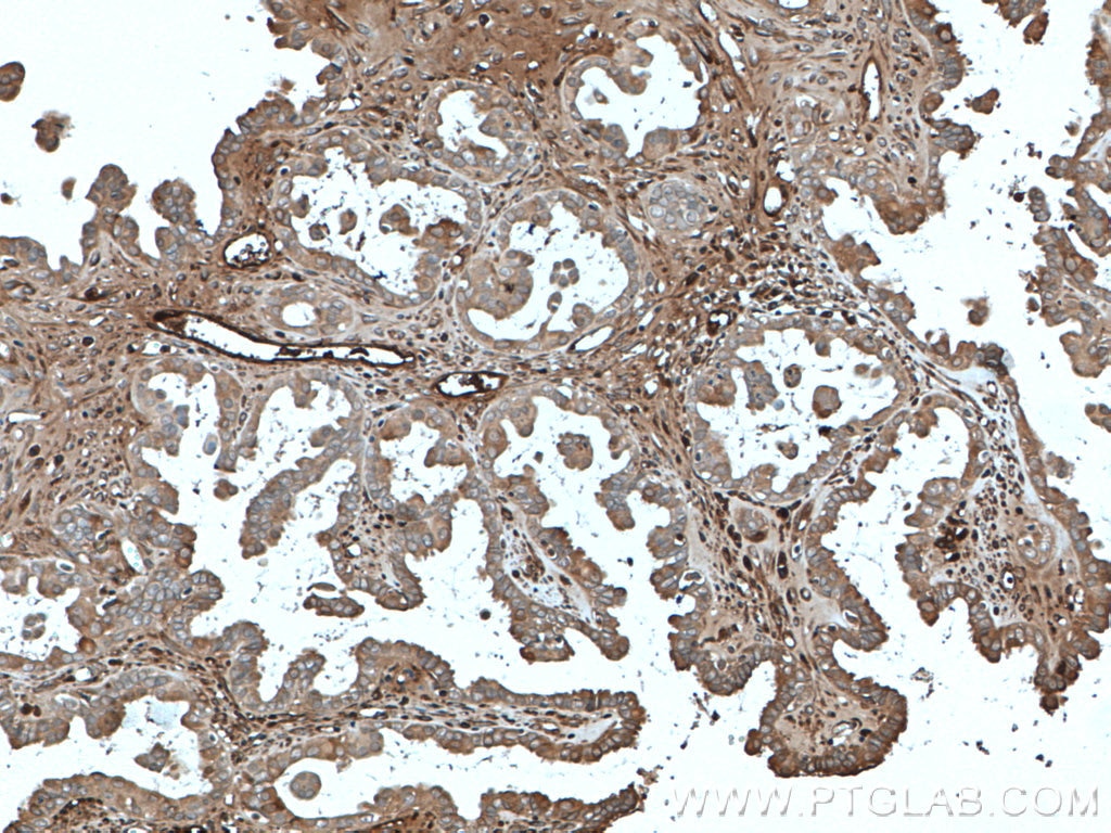 Immunohistochemistry (IHC) staining of human ovary tumor tissue using Ceruloplasmin Monoclonal antibody (66156-1-Ig)