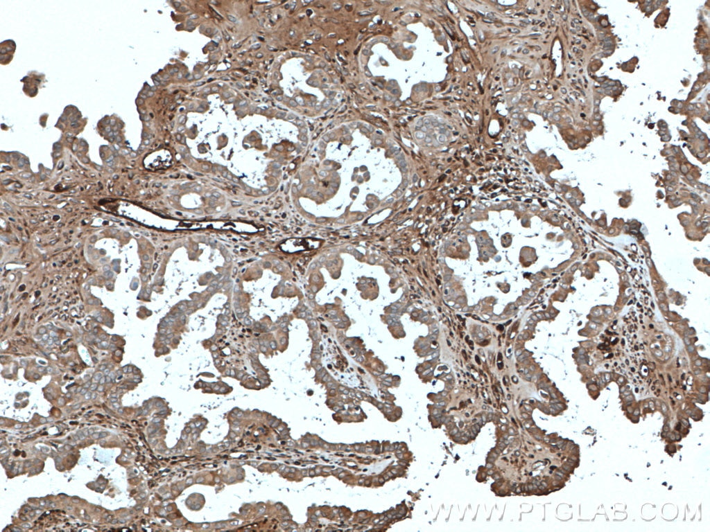 IHC staining of human ovary tumor using 66156-1-Ig