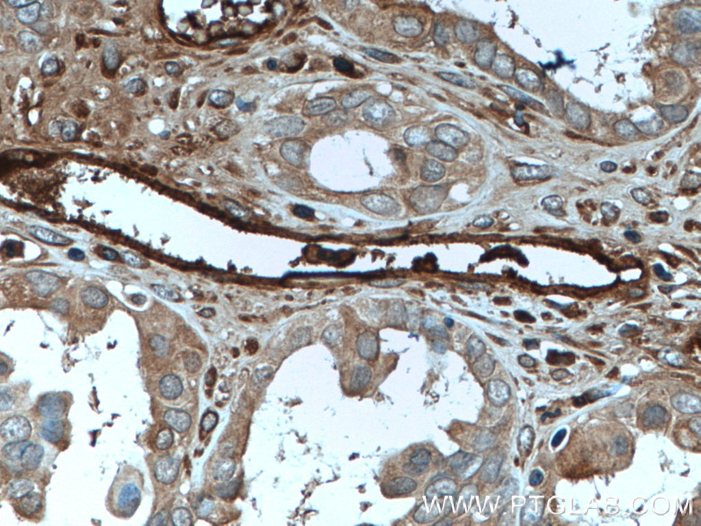 Immunohistochemistry (IHC) staining of human ovary tumor tissue using Ceruloplasmin Monoclonal antibody (66156-1-Ig)