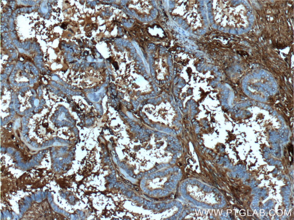 IHC staining of human ovary tumor using 66156-1-Ig