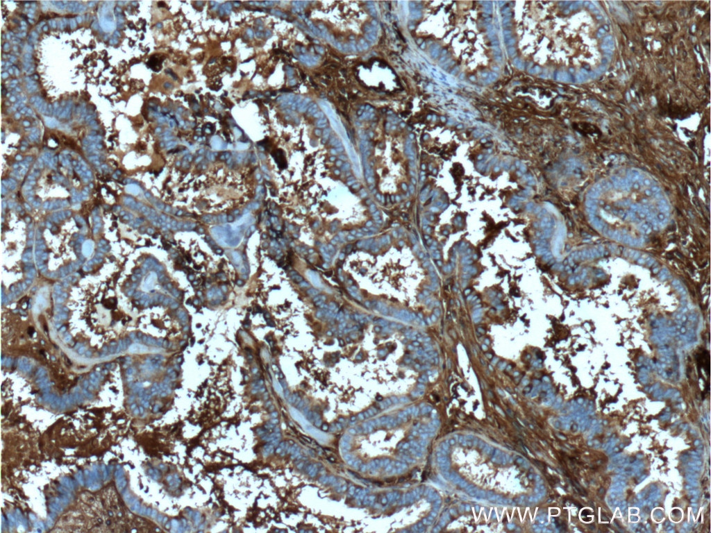 Immunohistochemistry (IHC) staining of human ovary tumor tissue using Ceruloplasmin Monoclonal antibody (66156-1-Ig)