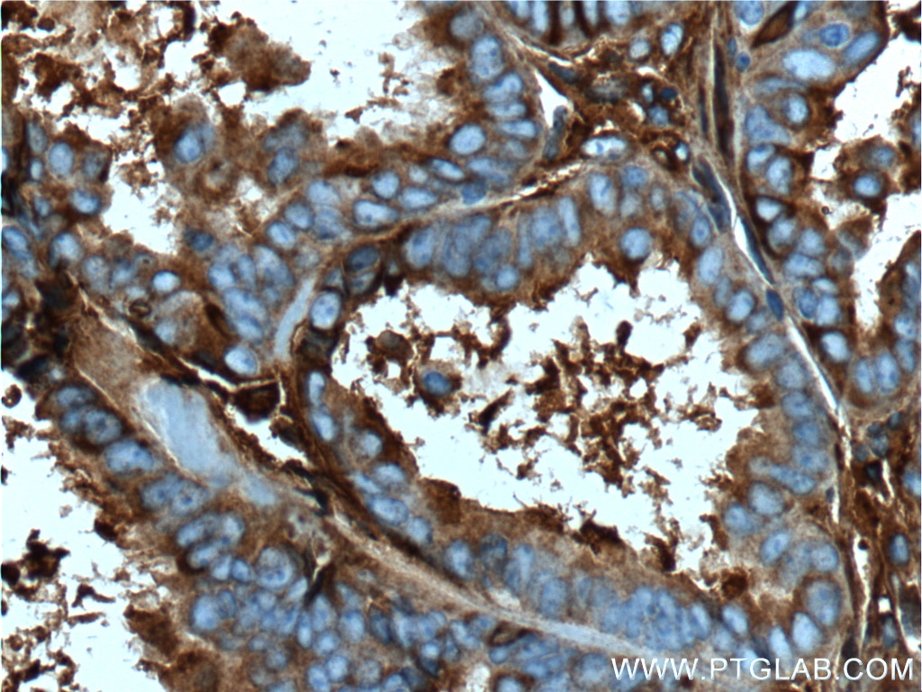 Immunohistochemistry (IHC) staining of human ovary tumor tissue using Ceruloplasmin Monoclonal antibody (66156-1-Ig)