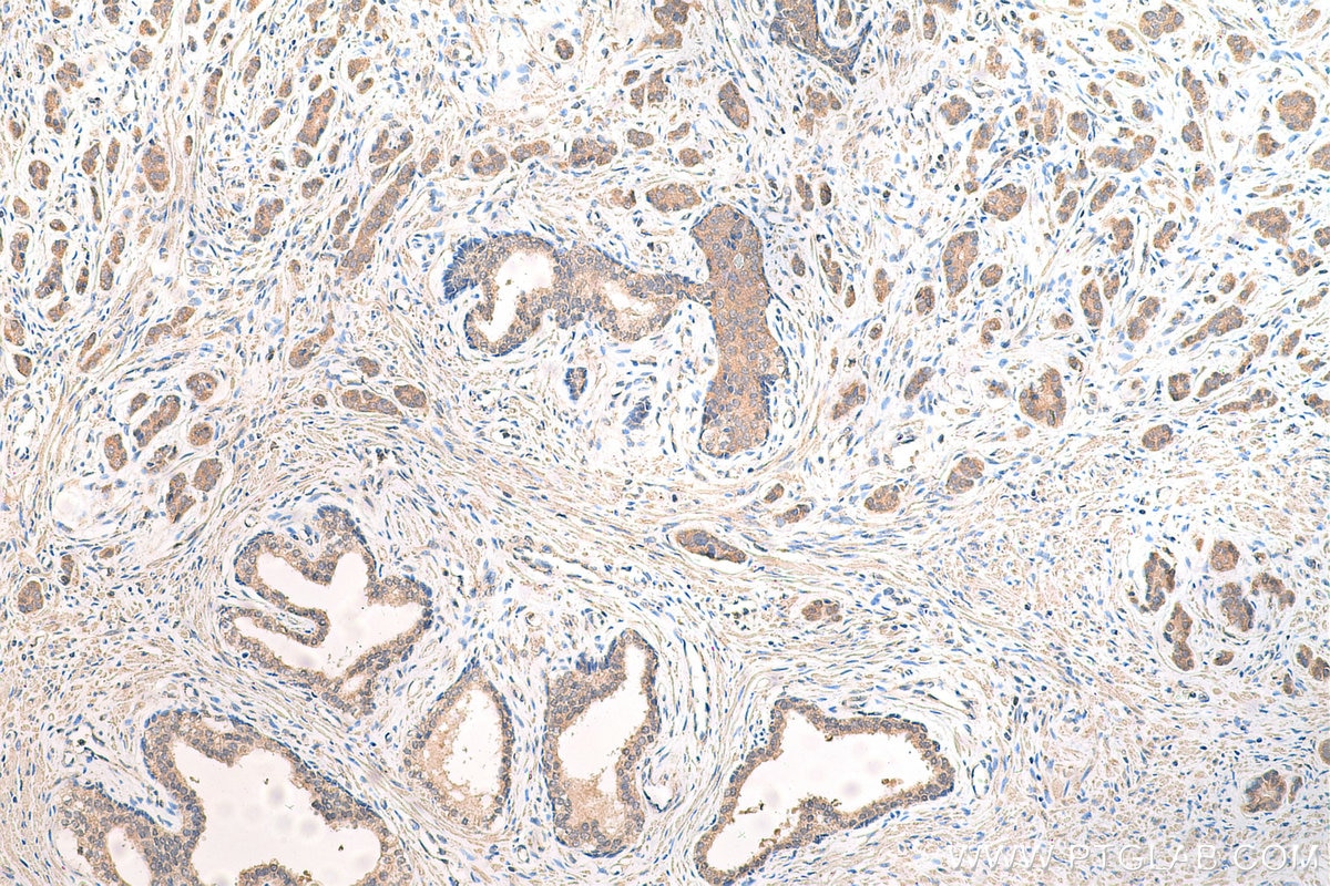 Immunohistochemistry (IHC) staining of human prostate cancer tissue using CP110 Polyclonal antibody (12780-1-AP)