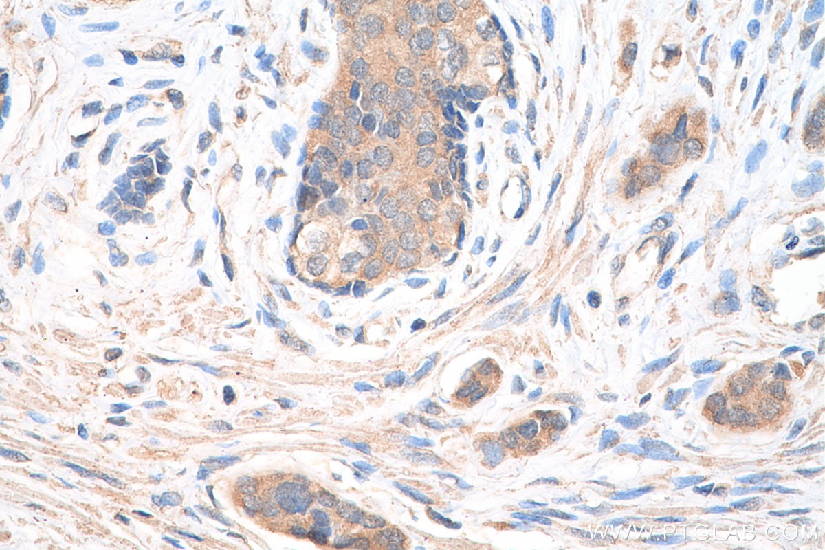 Immunohistochemistry (IHC) staining of human prostate cancer tissue using CP110 Polyclonal antibody (12780-1-AP)