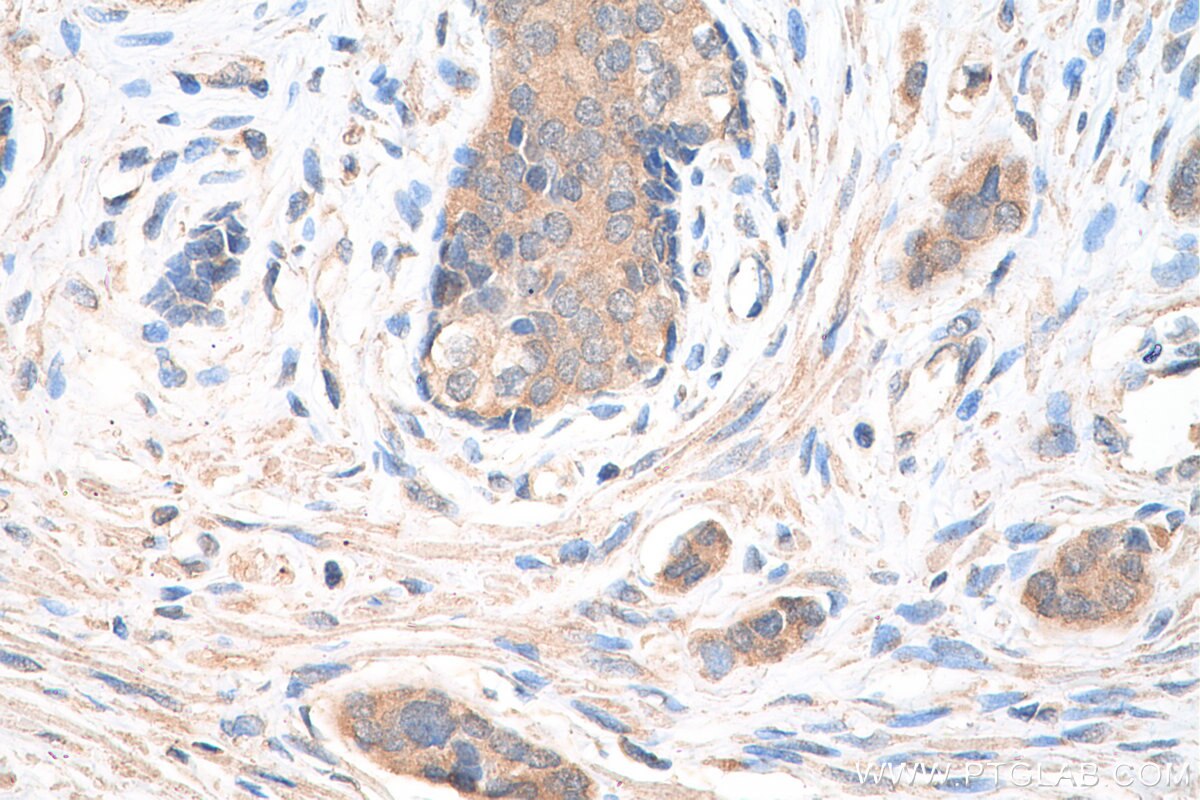 IHC staining of human prostate cancer using 12780-1-AP