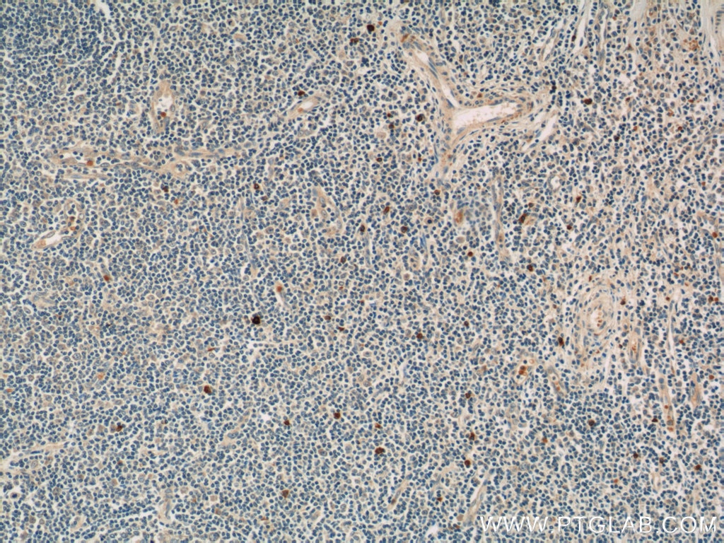 Immunohistochemistry (IHC) staining of human tonsillitis tissue using Carboxypeptidase A3 Polyclonal antibody (16236-1-AP)