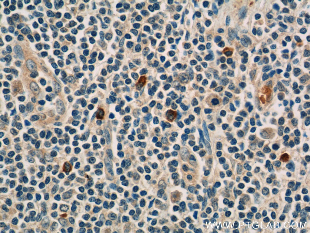 Immunohistochemistry (IHC) staining of human tonsillitis tissue using Carboxypeptidase A3 Polyclonal antibody (16236-1-AP)