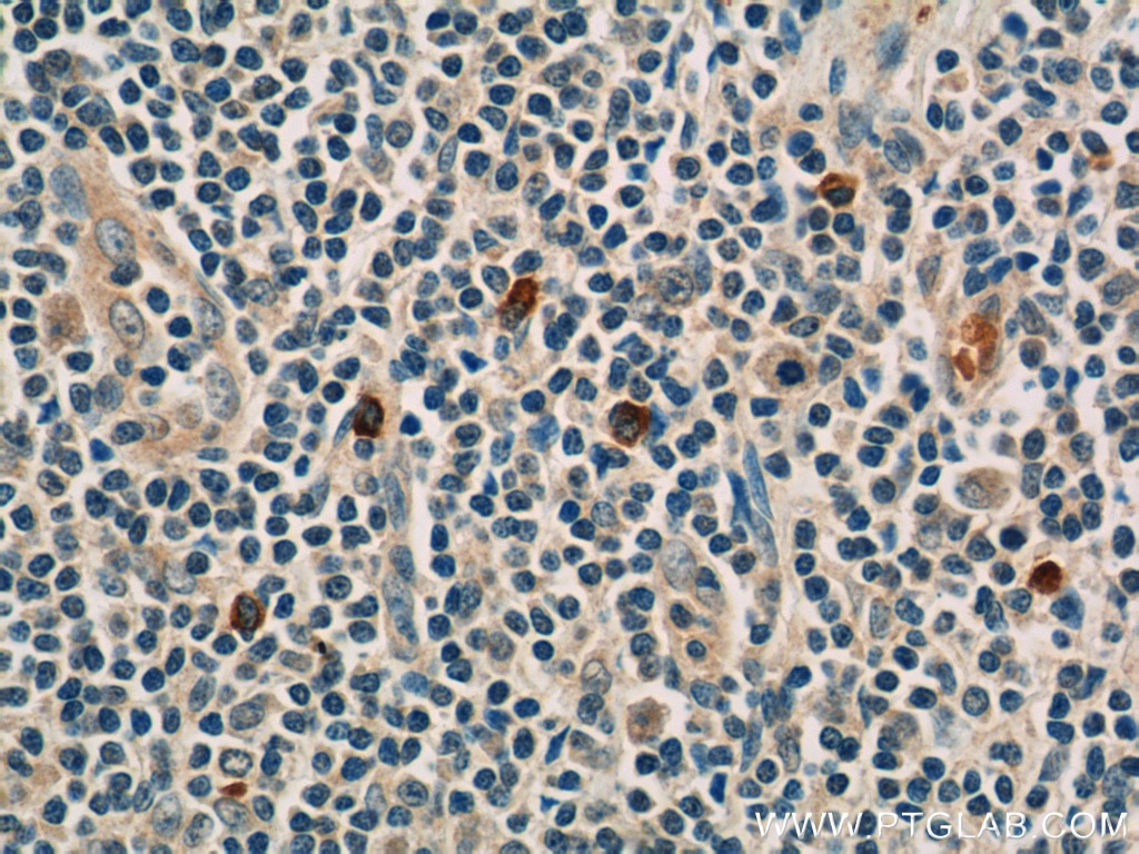 IHC staining of human tonsillitis using 16236-1-AP