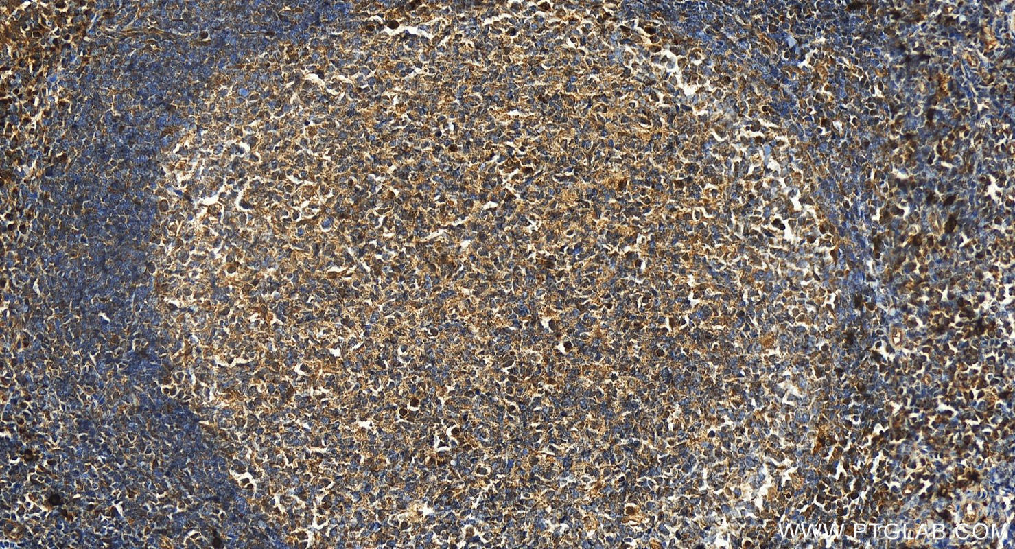 Immunohistochemistry (IHC) staining of human tonsillitis tissue using Carboxypeptidase A3 Polyclonal antibody (16236-1-AP)