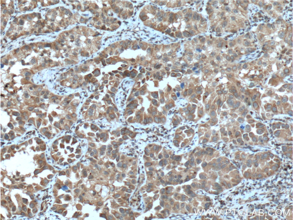 Immunohistochemistry (IHC) staining of human lung cancer tissue using CPA4 Polyclonal antibody (26824-1-AP)