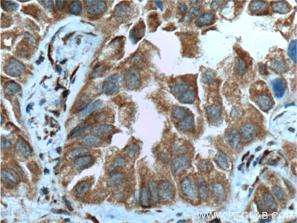 Immunohistochemistry (IHC) staining of human lung cancer tissue using CPA4 Polyclonal antibody (26824-1-AP)