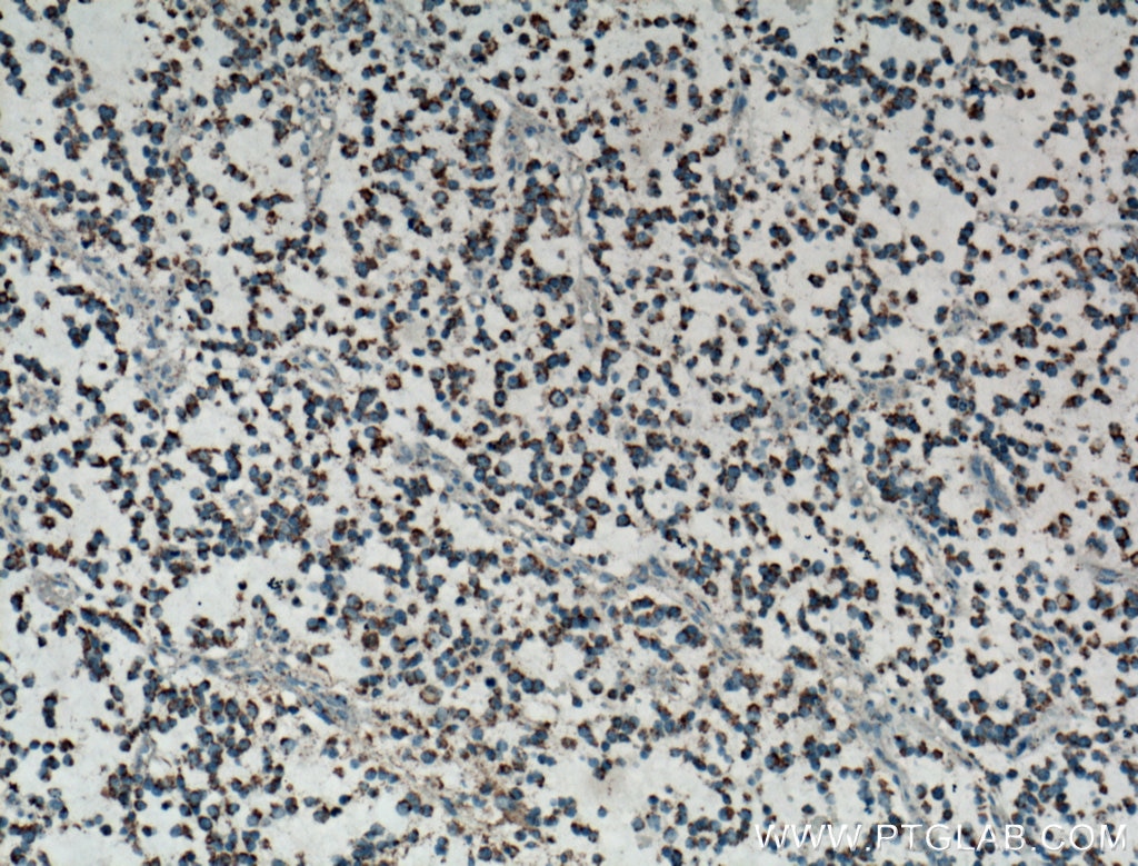 IHC staining of human gliomas using 13604-1-AP