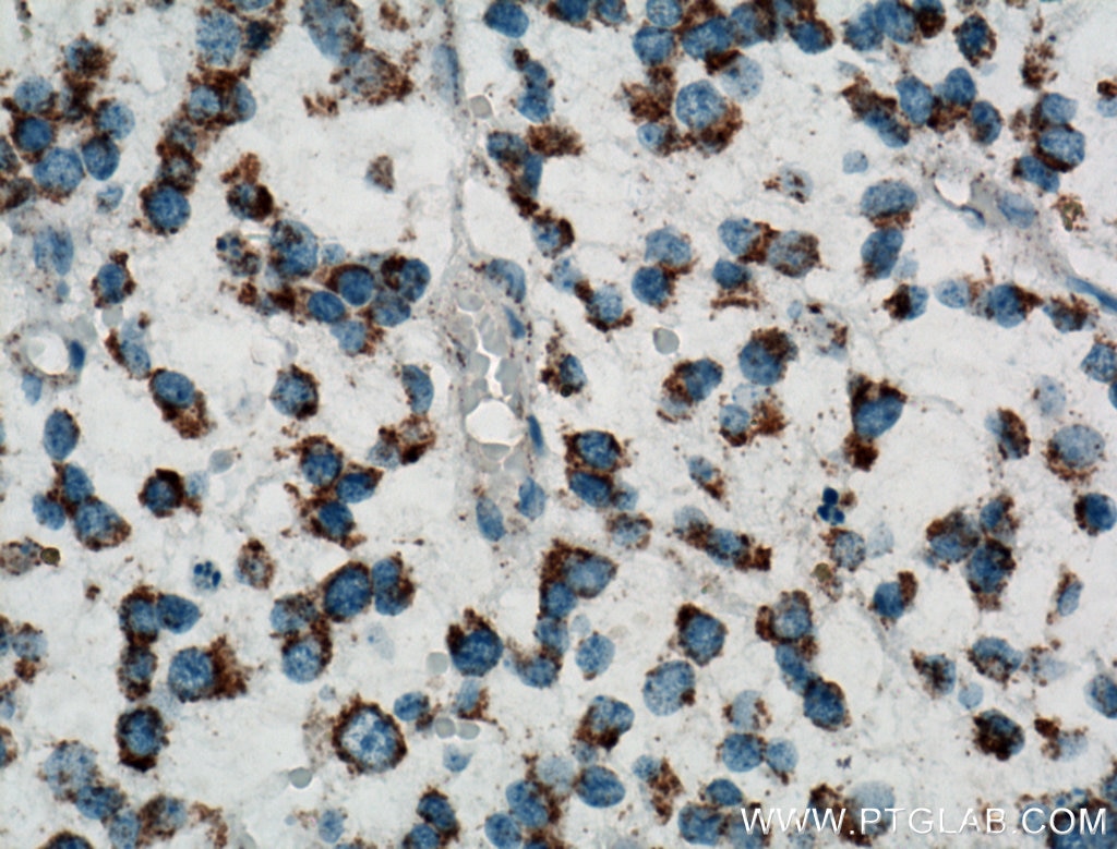 Immunohistochemistry (IHC) staining of human gliomas tissue using Carboxypeptidase A6 Polyclonal antibody (13604-1-AP)