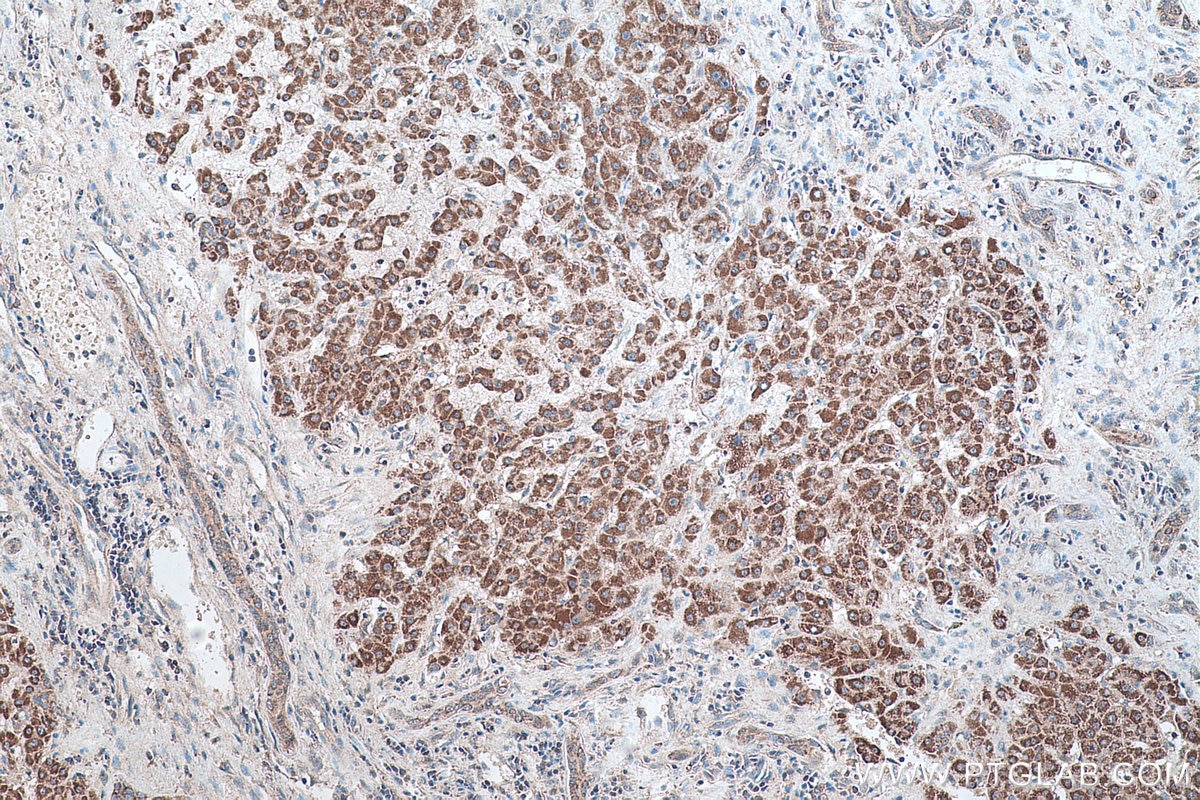 Immunohistochemistry (IHC) staining of human liver cancer tissue using Carboxypeptidase B2 Polyclonal antibody (10672-1-AP)