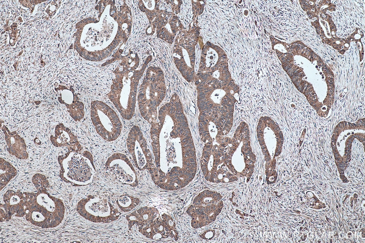 Immunohistochemistry (IHC) staining of human colon cancer tissue using Carboxypeptidase B2 Polyclonal antibody (10672-1-AP)