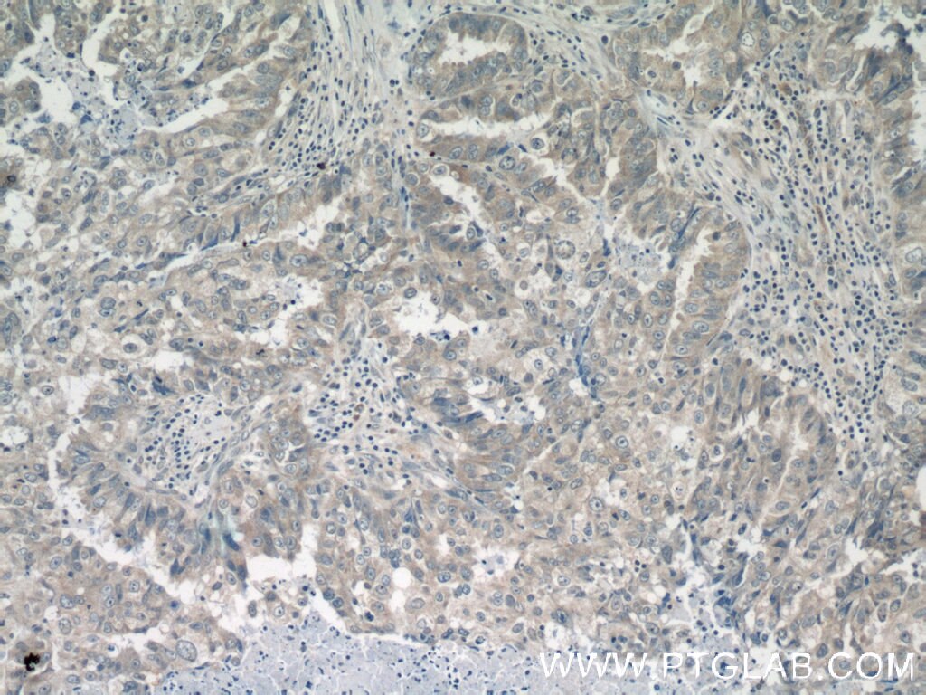 Immunohistochemistry (IHC) staining of human breast cancer tissue using CPEB1 Polyclonal antibody (13274-1-AP)
