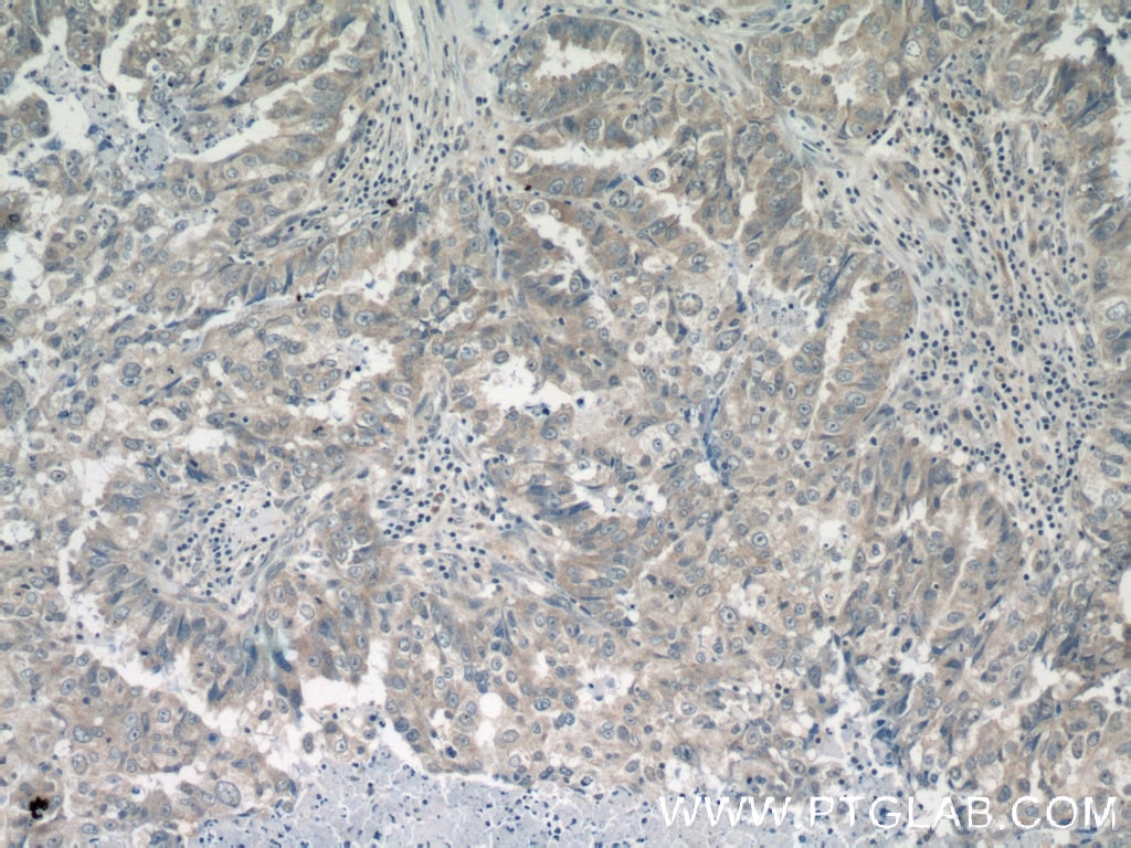 IHC staining of human breast cancer using 13274-1-AP