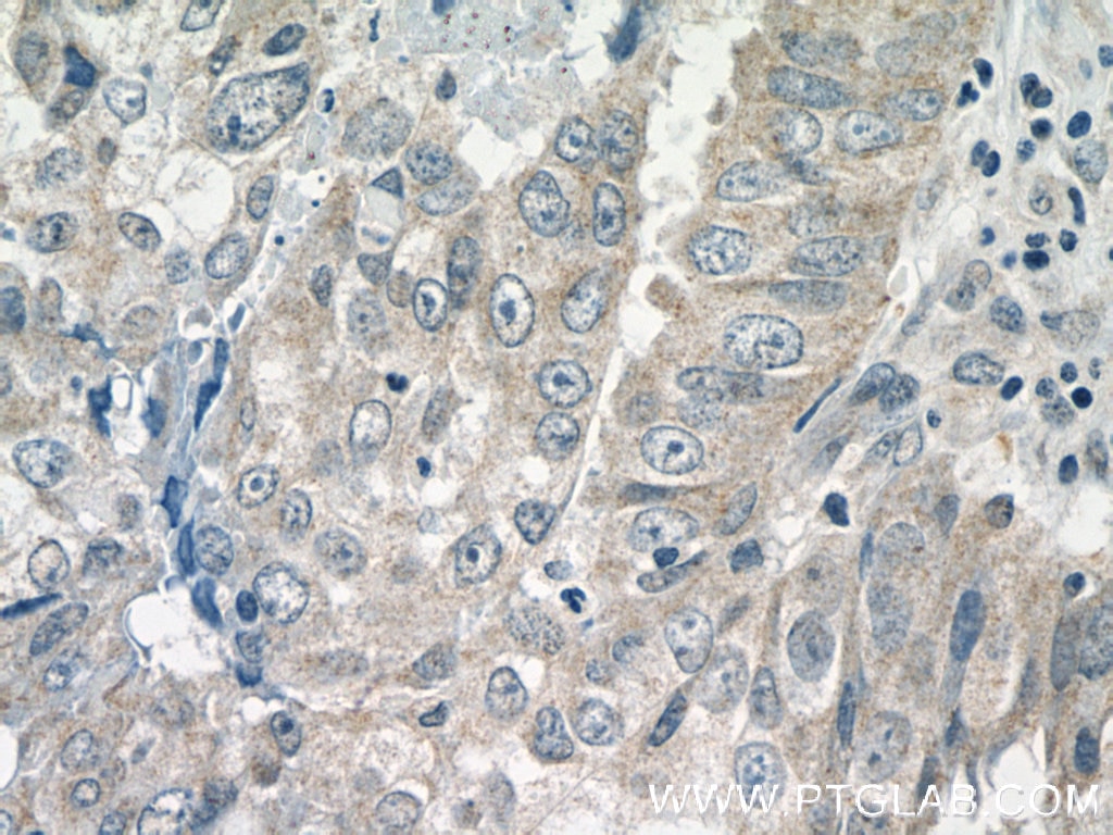 IHC staining of human breast cancer using 13274-1-AP