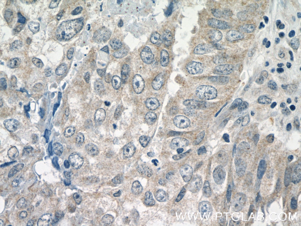 Immunohistochemistry (IHC) staining of human breast cancer tissue using CPEB1 Polyclonal antibody (13274-1-AP)