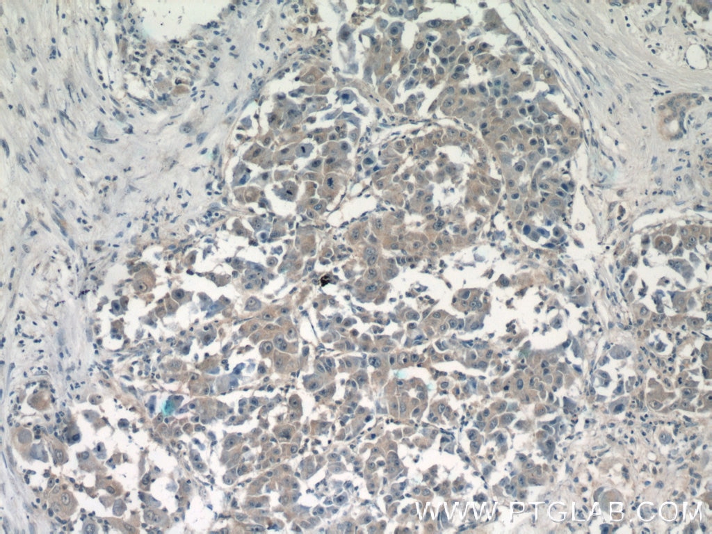 Immunohistochemistry (IHC) staining of human liver cancer tissue using CPEB1 Polyclonal antibody (13274-1-AP)