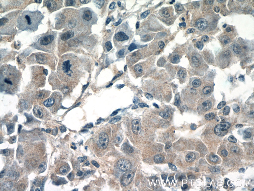Immunohistochemistry (IHC) staining of human liver cancer tissue using CPEB1 Polyclonal antibody (13274-1-AP)