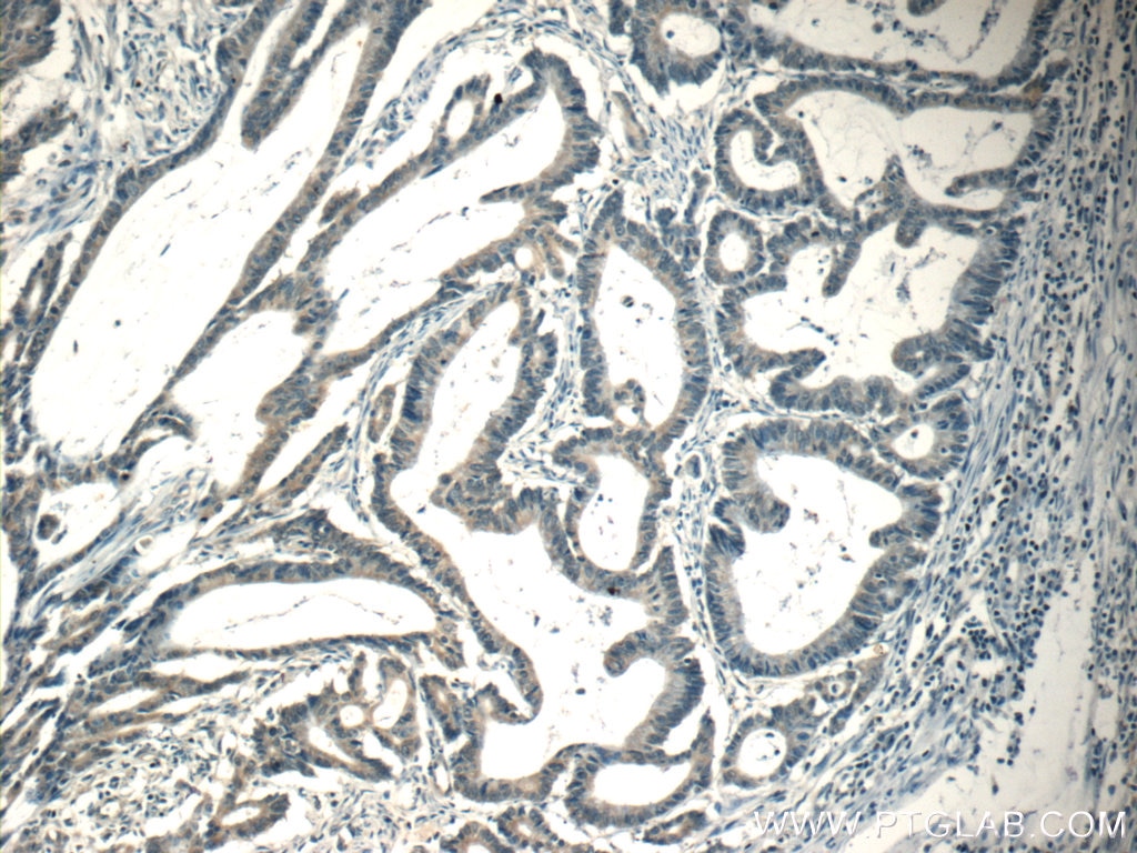 Immunohistochemistry (IHC) staining of human colon cancer tissue using CPEB1 Polyclonal antibody (13274-1-AP)