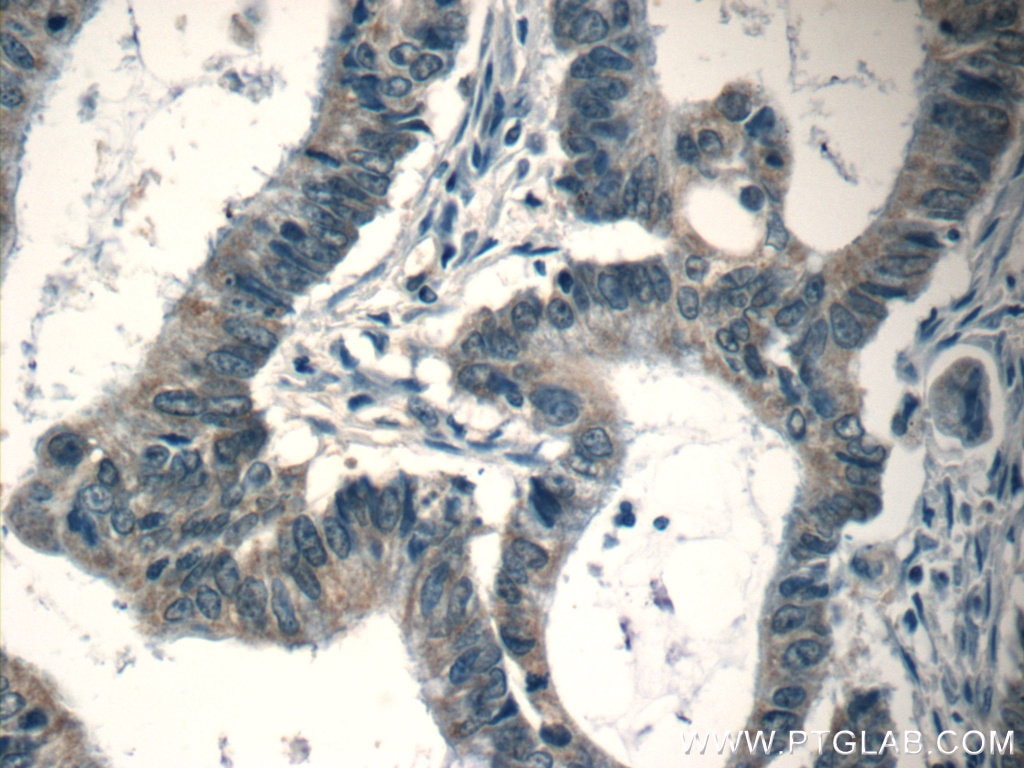 Immunohistochemistry (IHC) staining of human colon cancer tissue using CPEB1 Polyclonal antibody (13274-1-AP)