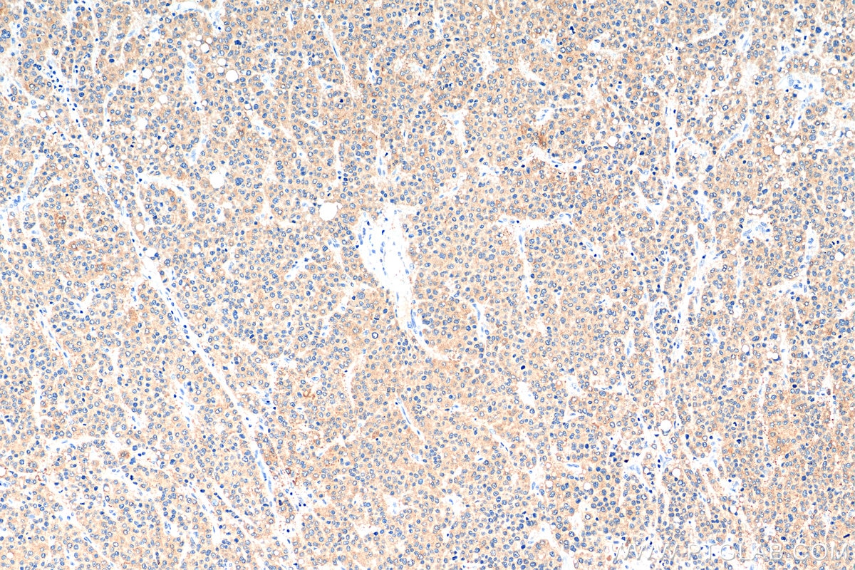 Immunohistochemistry (IHC) staining of human liver cancer tissue using CPEB1 Polyclonal antibody (13274-1-AP)