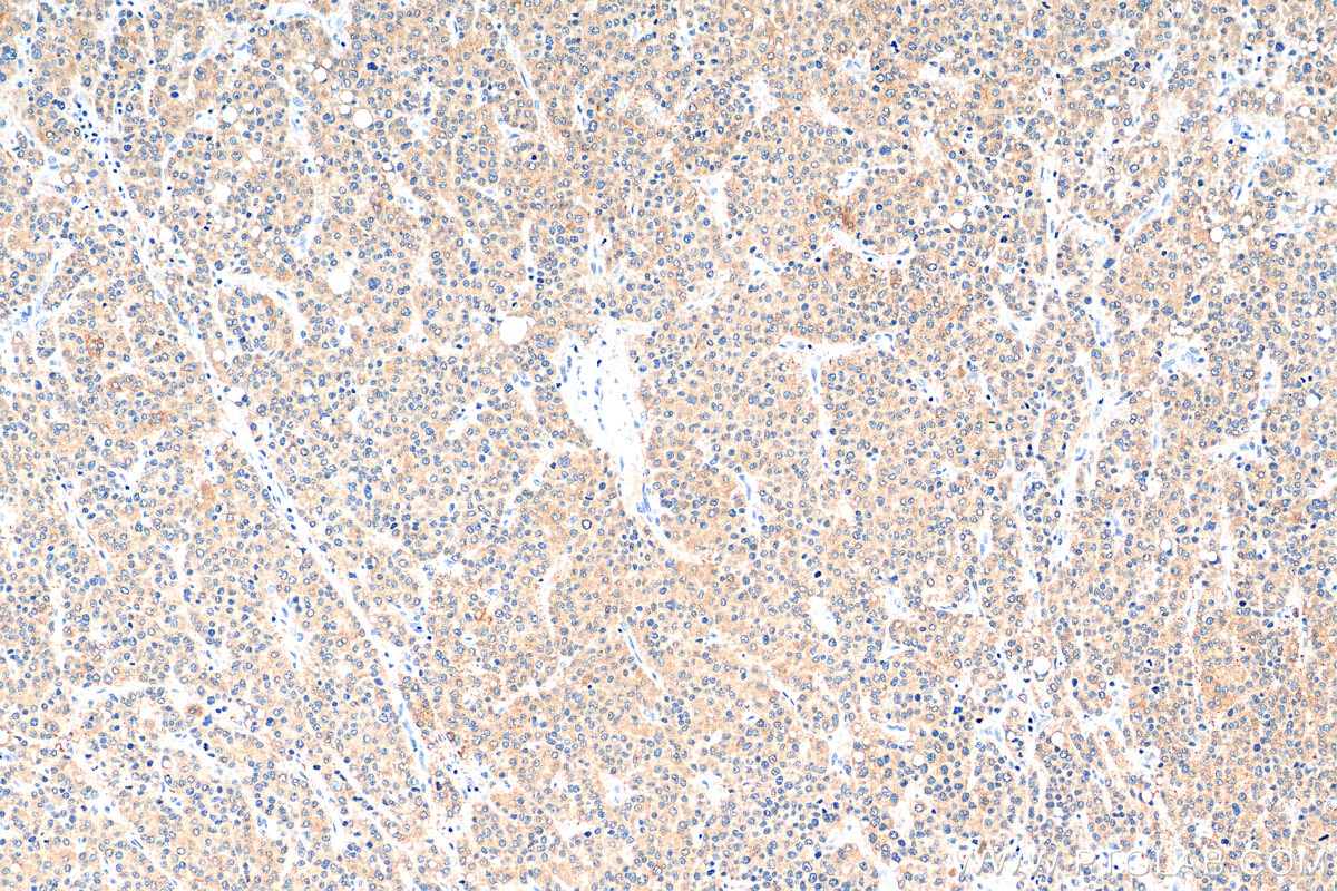 IHC staining of human liver cancer using 13274-1-AP