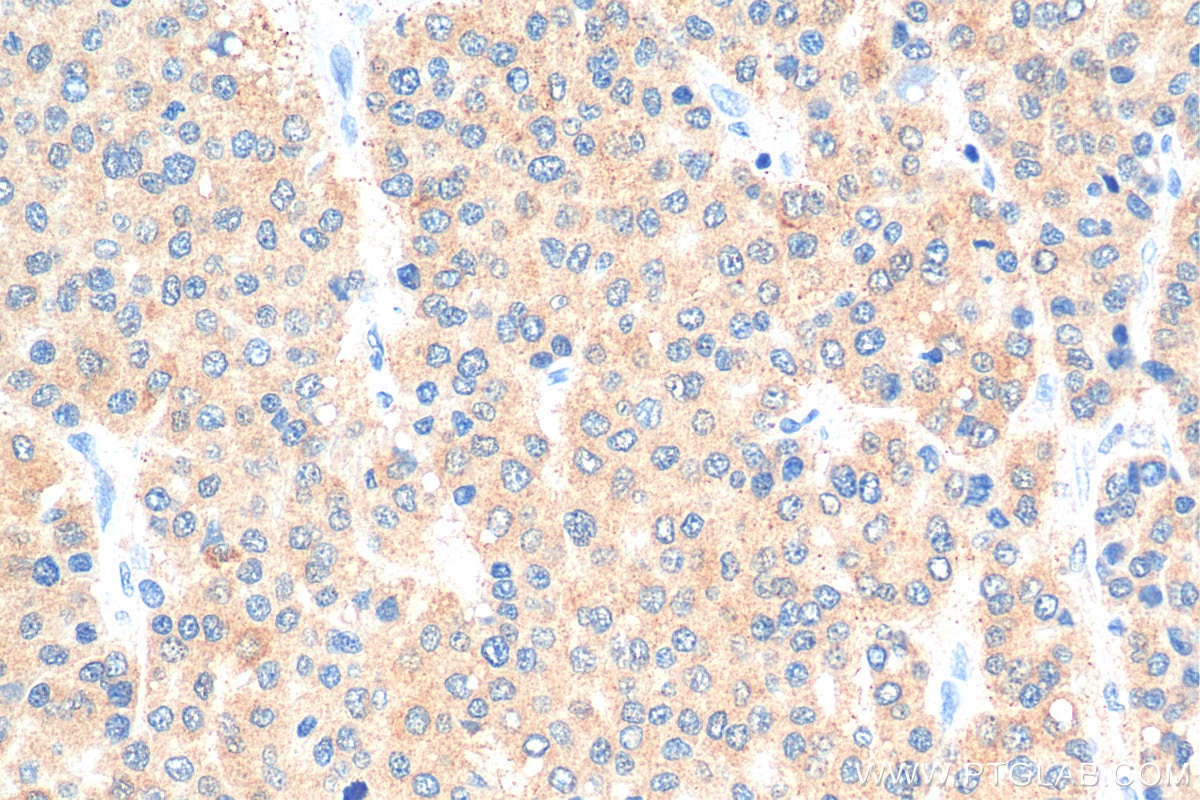 Immunohistochemistry (IHC) staining of human liver cancer tissue using CPEB1 Polyclonal antibody (13274-1-AP)