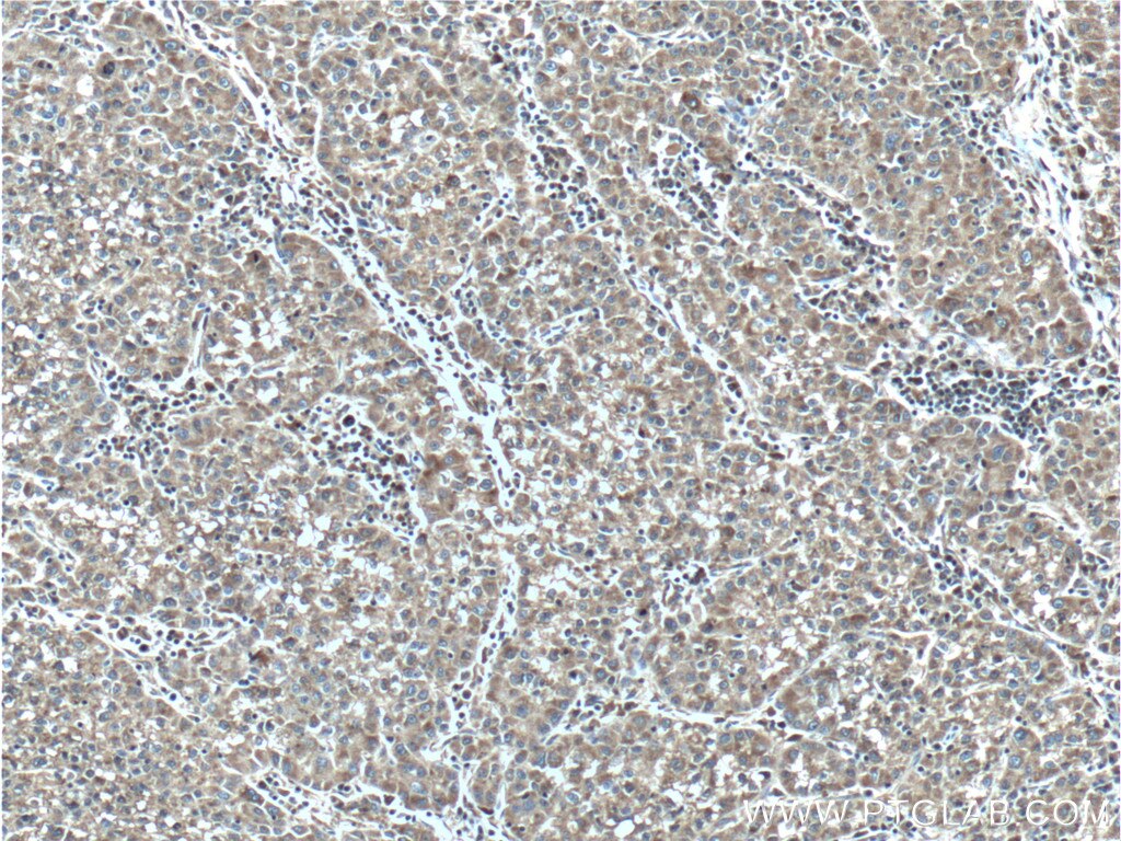 Immunohistochemistry (IHC) staining of human liver cancer tissue using CPEB4 Polyclonal antibody (25342-1-AP)