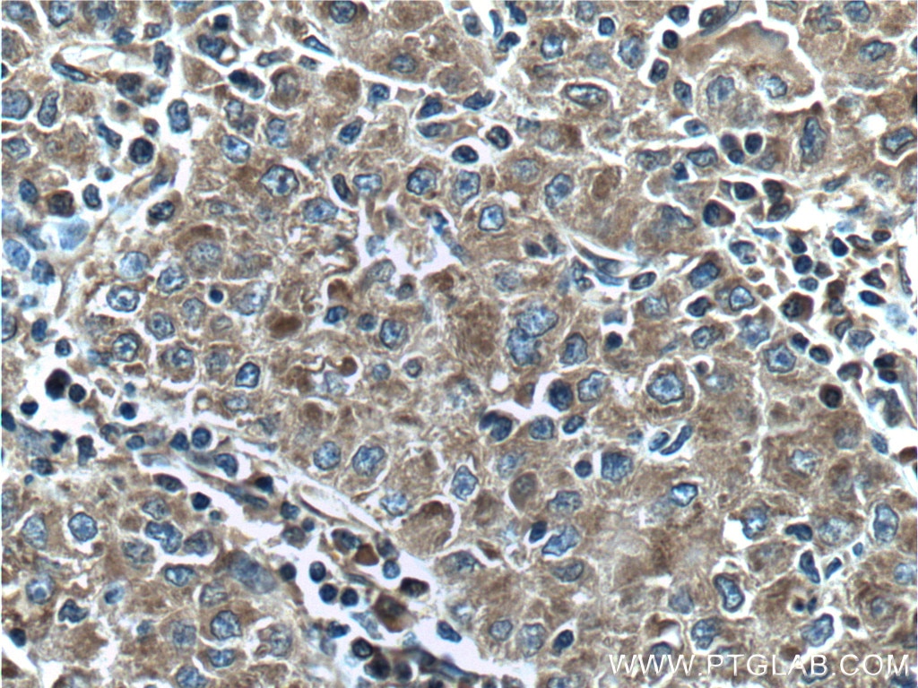 Immunohistochemistry (IHC) staining of human liver cancer tissue using CPEB4 Polyclonal antibody (25342-1-AP)