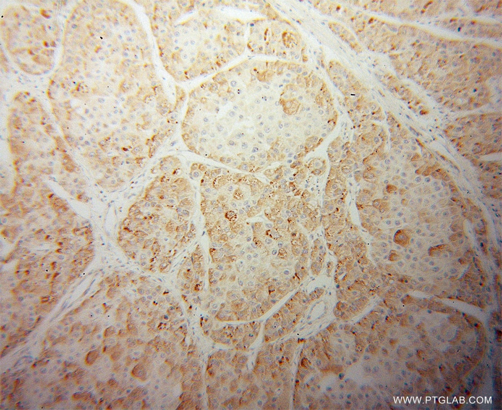 Immunohistochemistry (IHC) staining of human liver cancer tissue using CPN1 Polyclonal antibody (13385-1-AP)