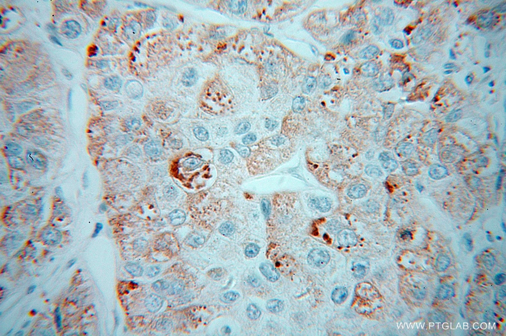 Immunohistochemistry (IHC) staining of human liver cancer tissue using CPN1 Polyclonal antibody (13385-1-AP)