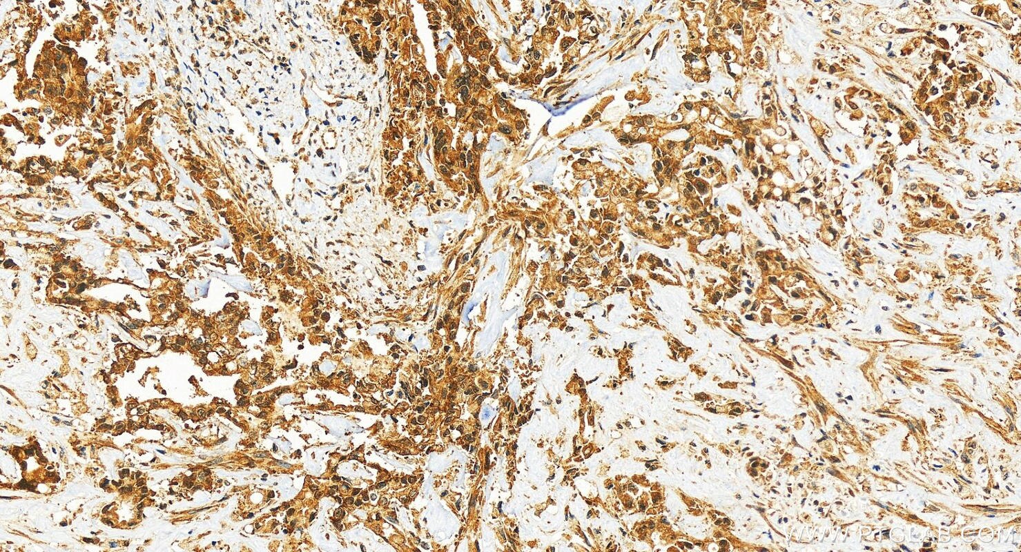 Immunohistochemistry (IHC) staining of human intrahepatic cholangiocarcinoma tissue using CPNE1 Polyclonal antibody (10126-2-AP)