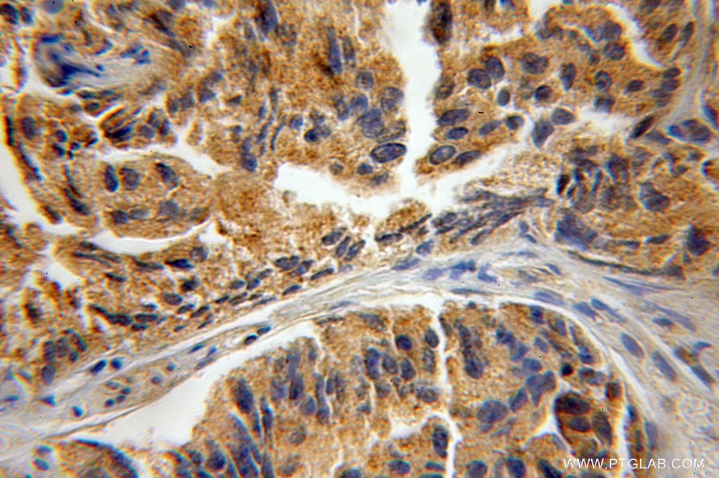 Immunohistochemistry (IHC) staining of human prostate cancer tissue using CPNE3 Polyclonal antibody (11186-1-AP)