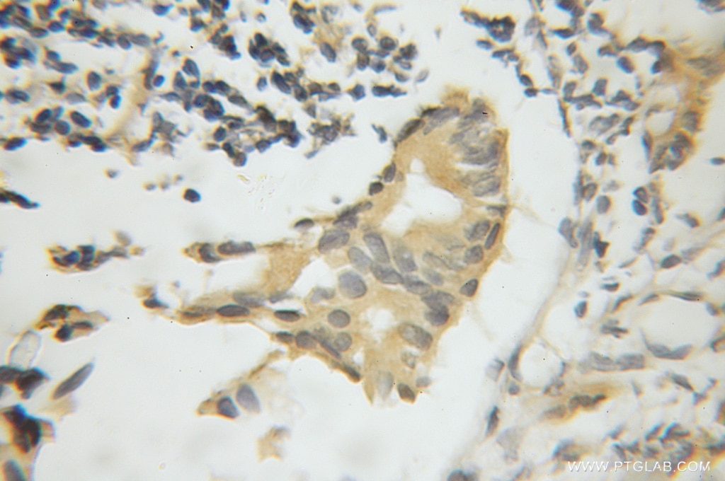 Immunohistochemistry (IHC) staining of human prostate cancer tissue using CPNE3 Polyclonal antibody (11186-1-AP)