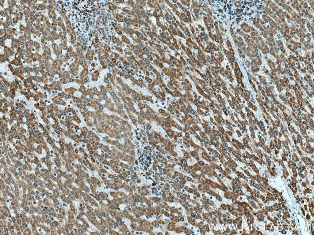 Immunohistochemistry (IHC) staining of human liver cancer tissue using CPOX Polyclonal antibody (12211-1-AP)