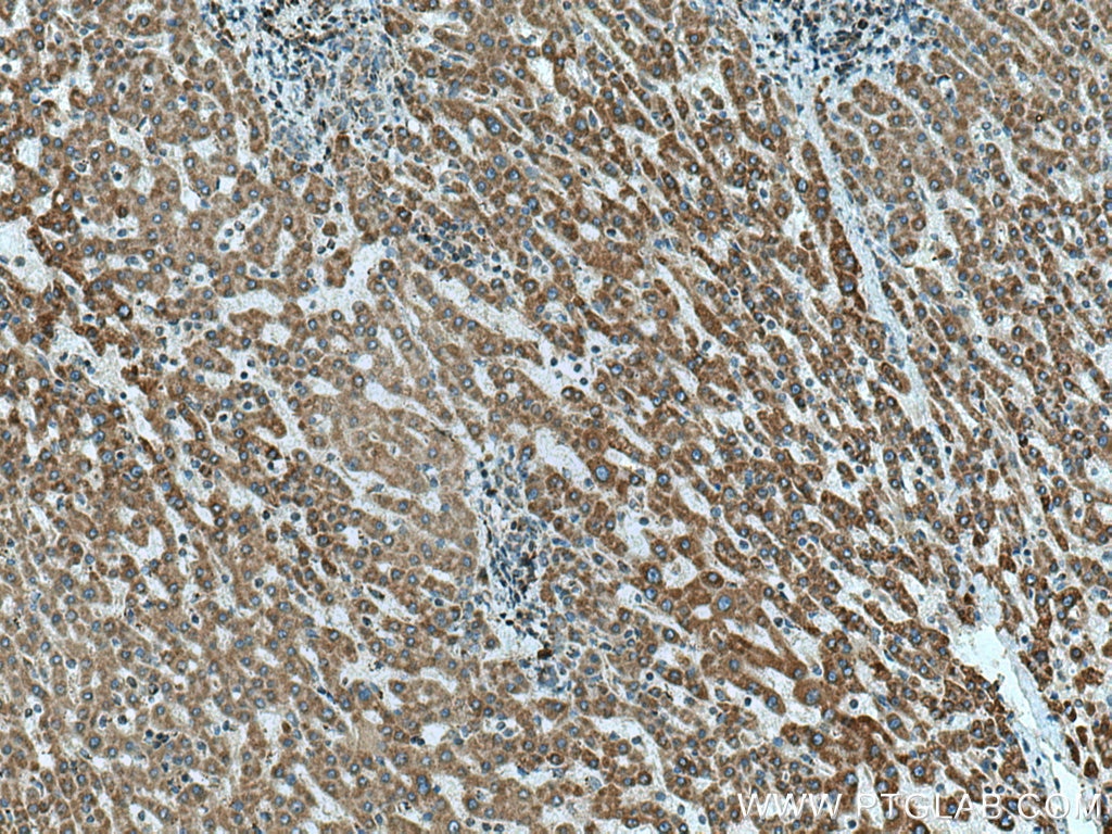 IHC staining of human liver cancer using 12211-1-AP