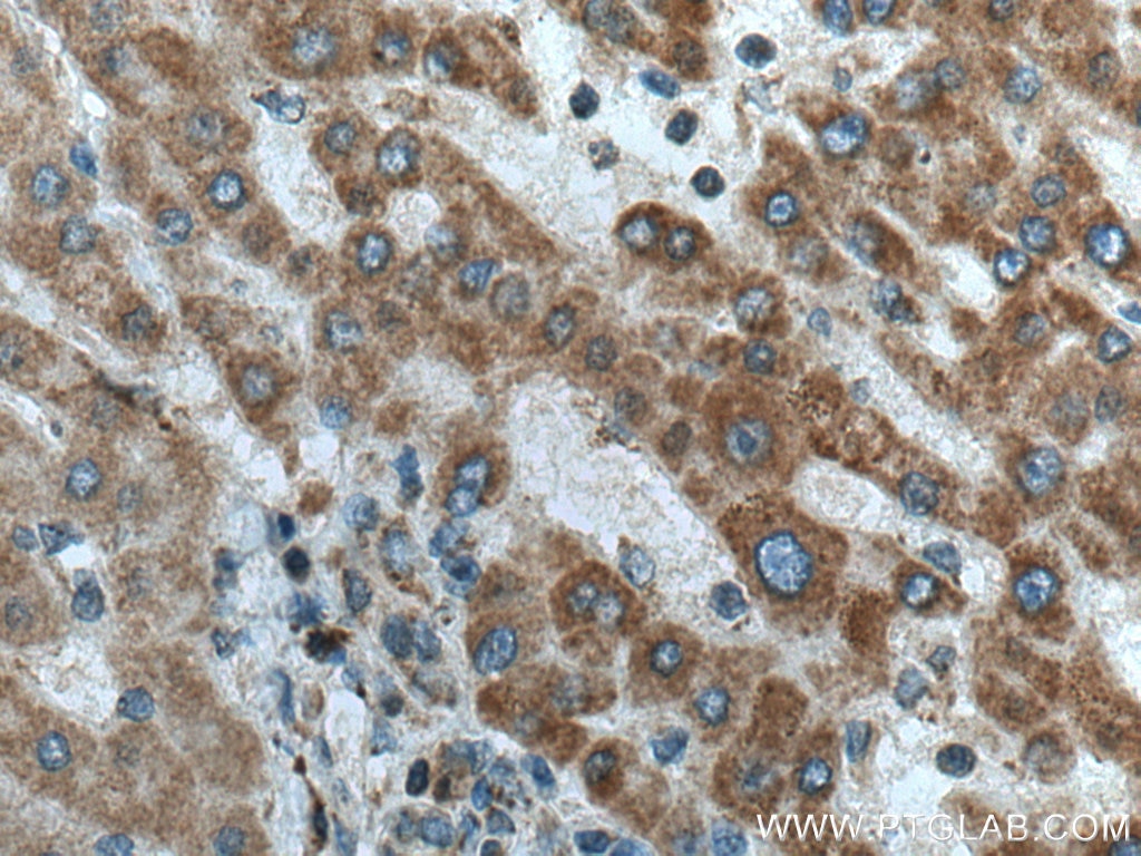 Immunohistochemistry (IHC) staining of human liver cancer tissue using CPOX Polyclonal antibody (12211-1-AP)